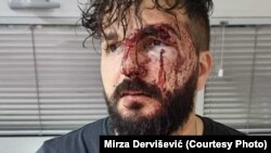 Mirza Dervišević, novinar i urednik iz Brčkog, nakon napada metalnim bokserom 19. avgusta 2023. godine. Tužilaštvo još uvijek nije podiglo optužnicu protiv napadača.
(Foto: Facebook)