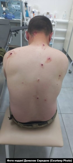 Осколкові поранення зустрічались часто