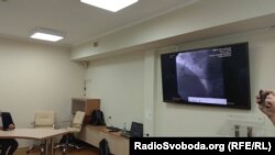 Бекірову імплантували два стенти