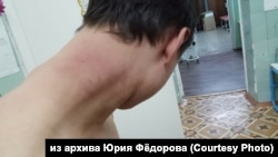 Избитый житель Тайшета Юрий Фёдоров