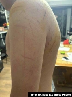 15 წლის მოზარდის სხეული, რომელსაც ტანზე დანით აქვს მიყენებული ჭრილობები