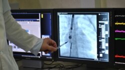 Введення оклюдера і сенсорів до аорти. Зображення передається з сенсора на екран