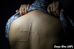 Світлина із фотопроєкту Зої Шу «Після полону»: колишній заручник угруповання «ДНР» Богдан Сергієць показує шрами, які залишились після того, як бойовики російських гібридних сил вирізали свастику на його спині. Фото 2019 року