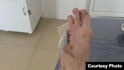 После ранения Дзатте Мамитову ампутировали полступни