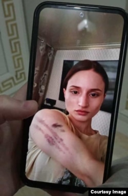 აიშატ ბაიმურადოვას ფოტო რომელზეც ჩანს ძალადობის კვალი