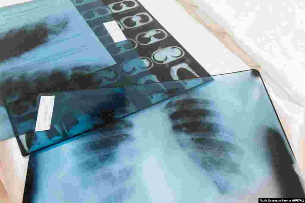 Снимки компьютерной томографии легких одного из пациентов на столе врача "красной" зоны