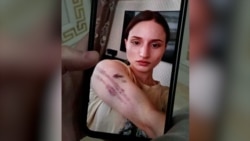 Фотография погибшей в Армении уроженки Чечни Айшат Баймурадовой со следами домашнего насилия