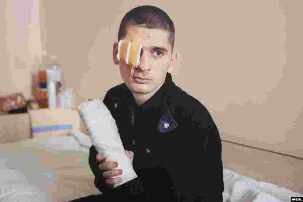 Голдиш Сергій. Отримав важкі поранення руки, одне око довелося видалити. Фото Олександра Чекменьова