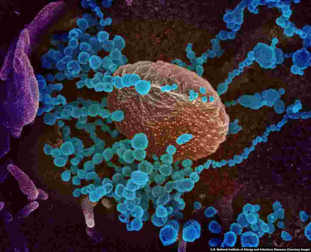 Віріони SARS-CoV-2, що розростаються в клітині людського організму. Всі фотографії в цій галереї розфарбовані з використанням спеціальних програм і Photoshop’у