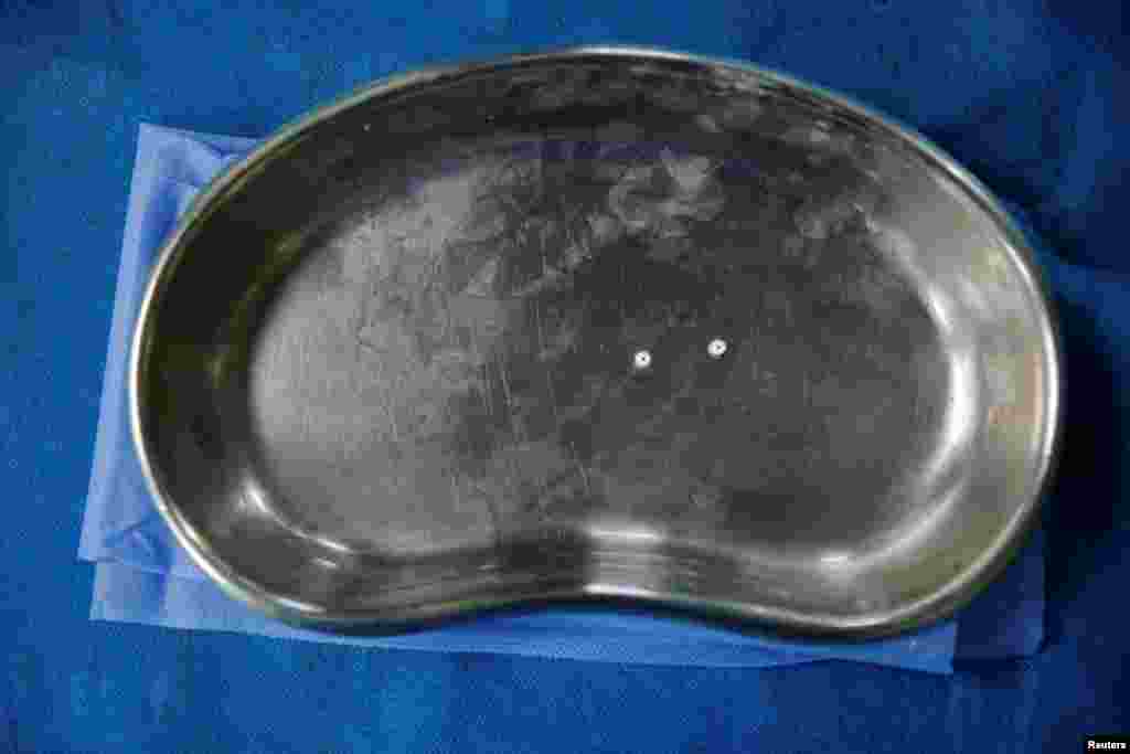 Стерилизацию проводят с помощью эластичных «колец Юна». Ими перетягивают фаллопиевые трубы, чтобы сделать оплодотворение невозможным